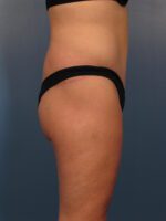 Belt Lipectomy - Case 1047b - After