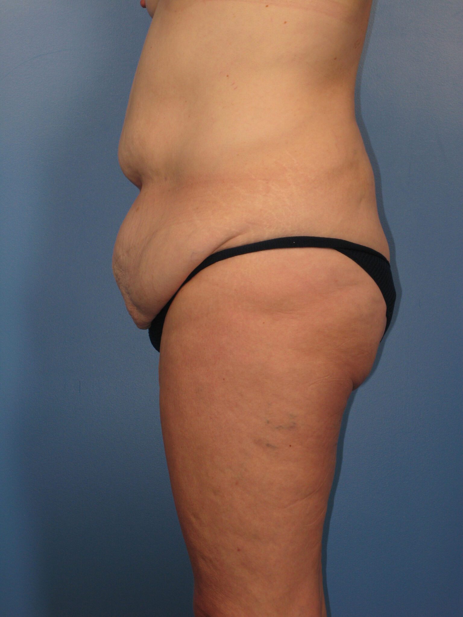 Belt Lipectomy Patient Photo - Case 1047b - before view-1