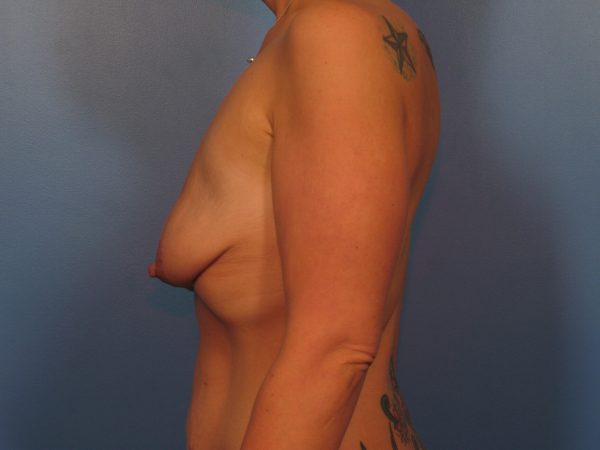 Case 1042a - Before