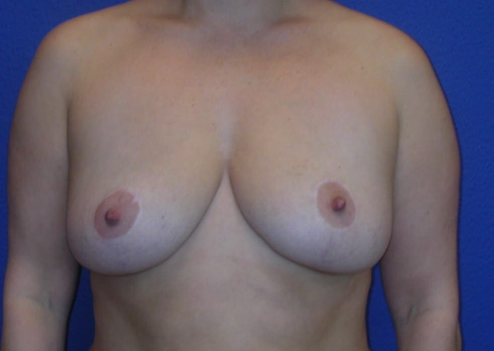 Breast Lift Patient Photo - Case 61 - after view-1