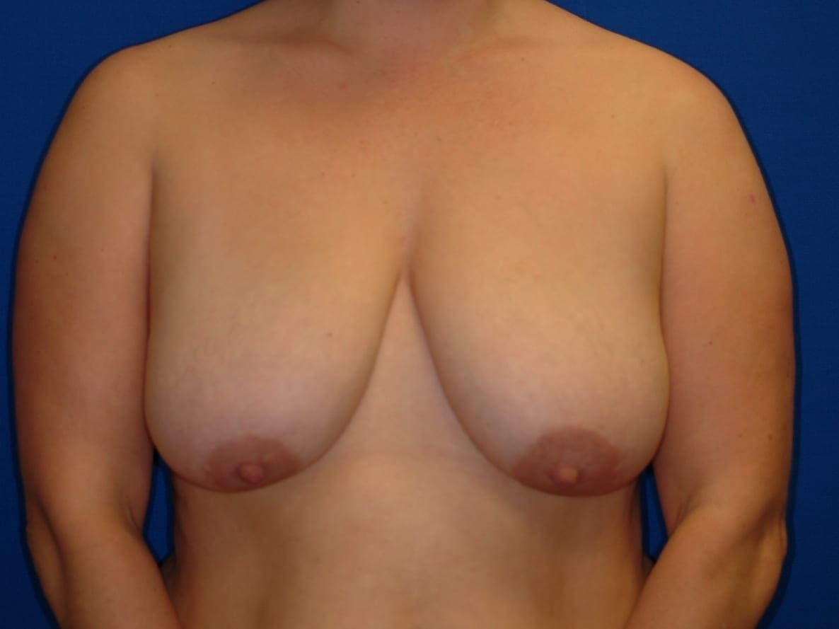 Breast Lift Patient Photo - Case 61 - before view-1
