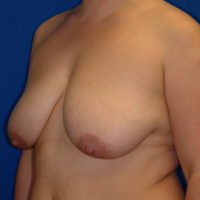 Breast Lift - Case 61 - Before