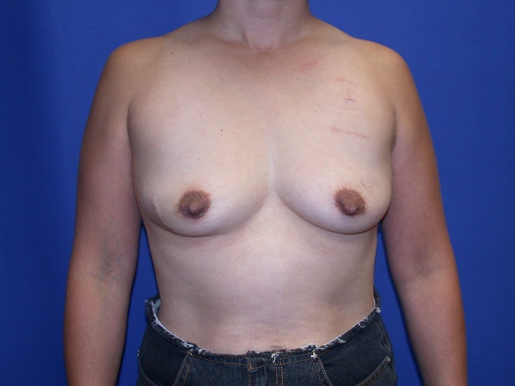 Breast Reconstruction Patient Photo - Case 73 - before view-1