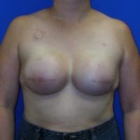 Breast Reconstruction - Case 73 - After