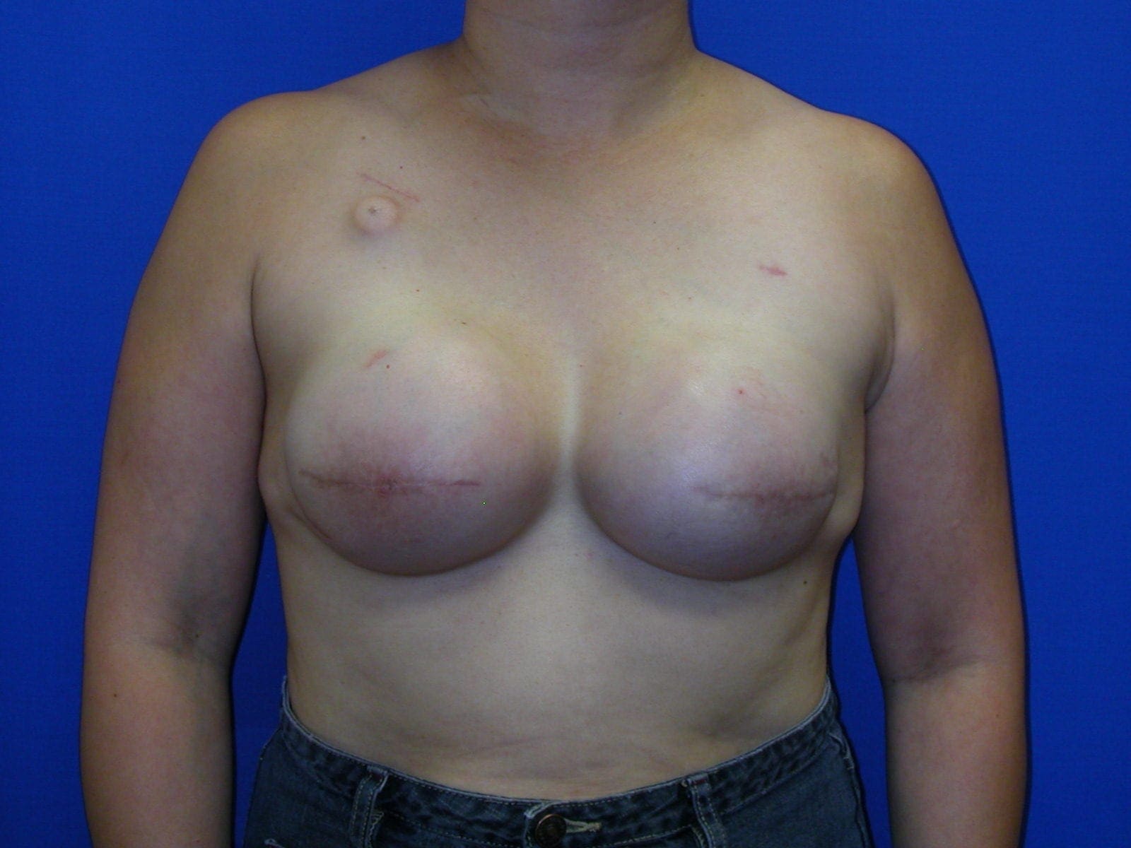Breast Reconstruction Patient Photo - Case 73 - after view