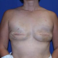 Breast Reconstruction - Case 73 - Before