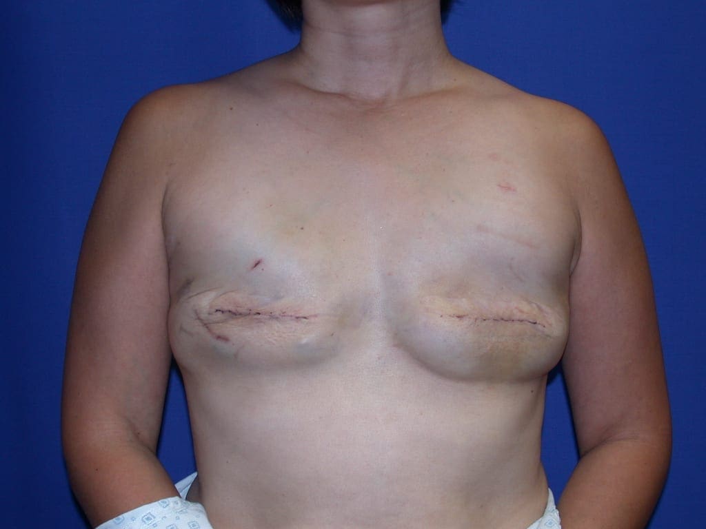 Breast Reconstruction Patient Photo - Case 73 - before view-