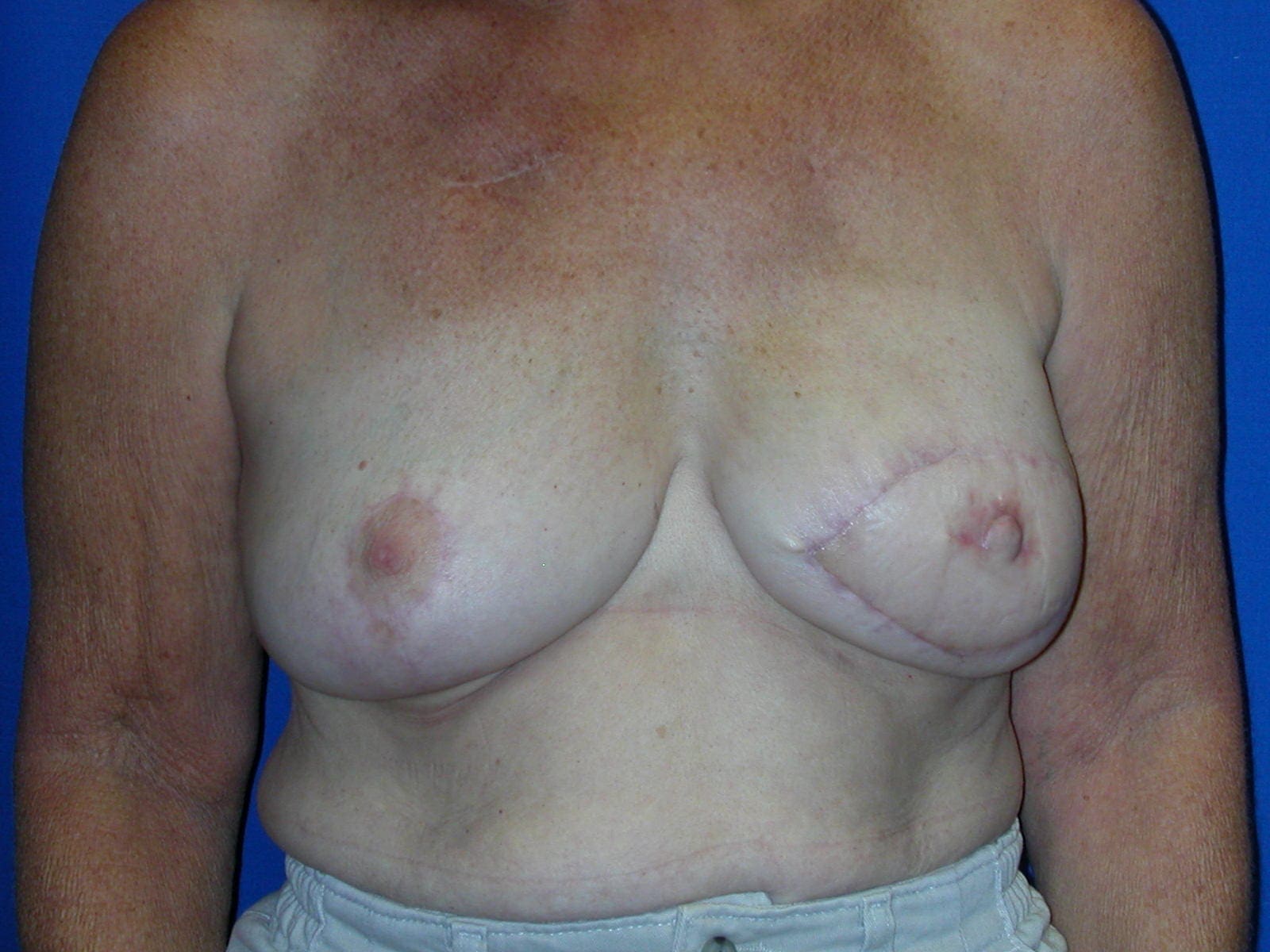 Breast Reconstruction - Case 75 - After