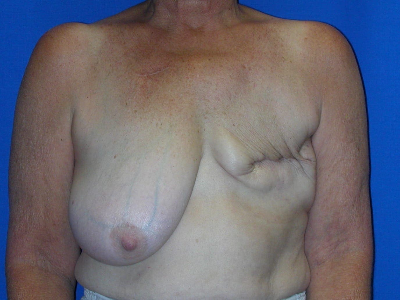 Breast Reconstruction - Case 75 - Before