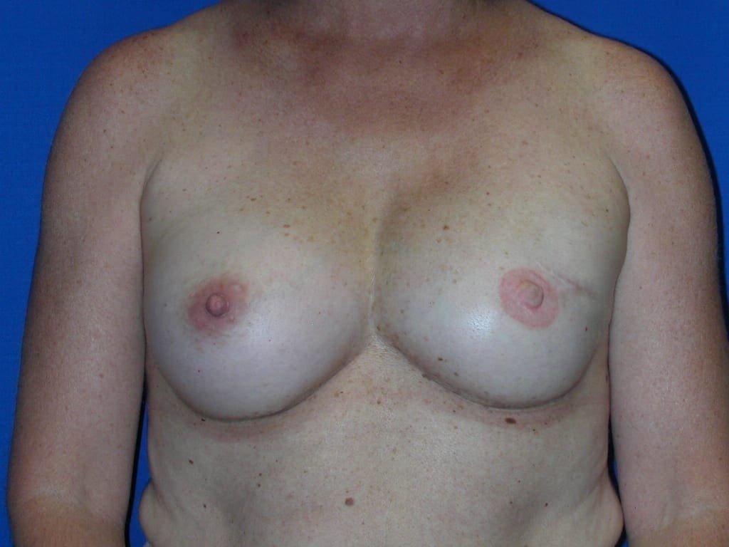 Breast Reconstruction - Case 77 - After