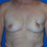 Breast Reconstruction - Case 77 - Before