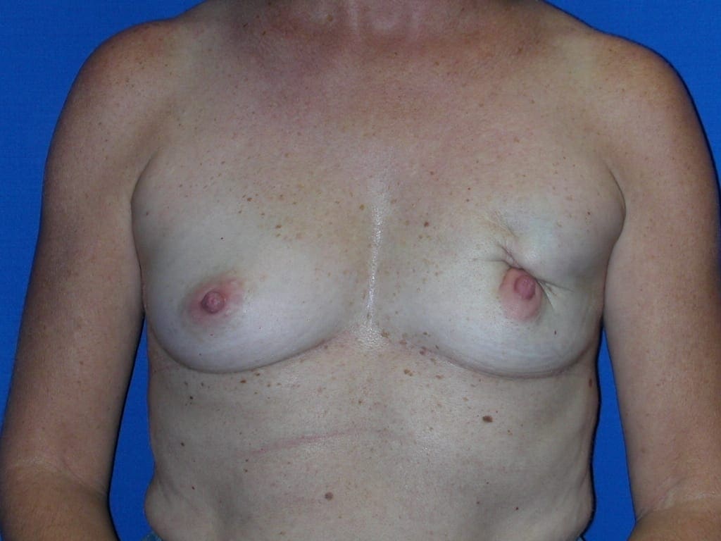 Breast Reconstruction Patient Photo - Case 77 - before view-0