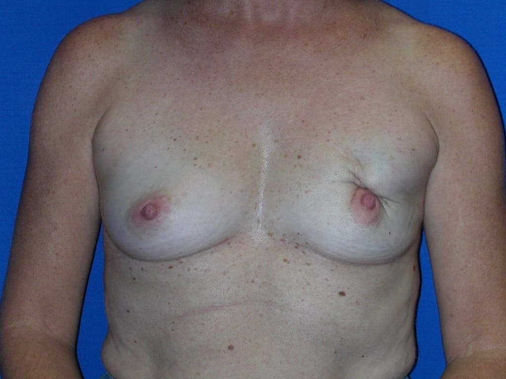 Breast Reconstruction Patient Photo - Case 77 - before view-