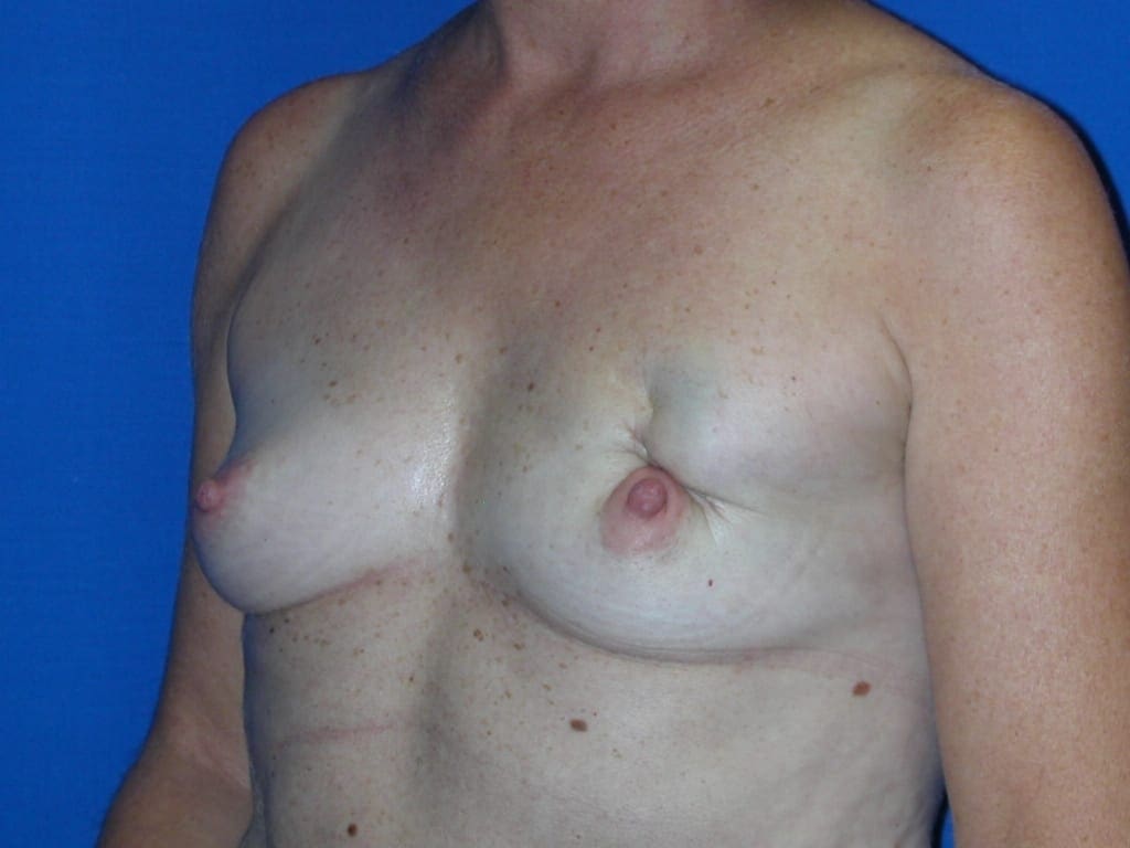 Breast Reconstruction Patient Photo - Case 77 - before view-1