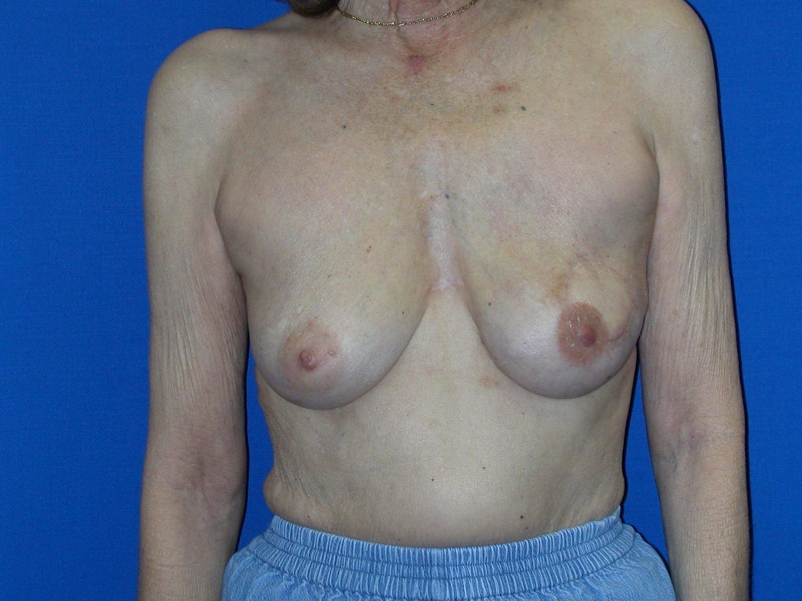 Breast Reconstruction - Case 79 - After