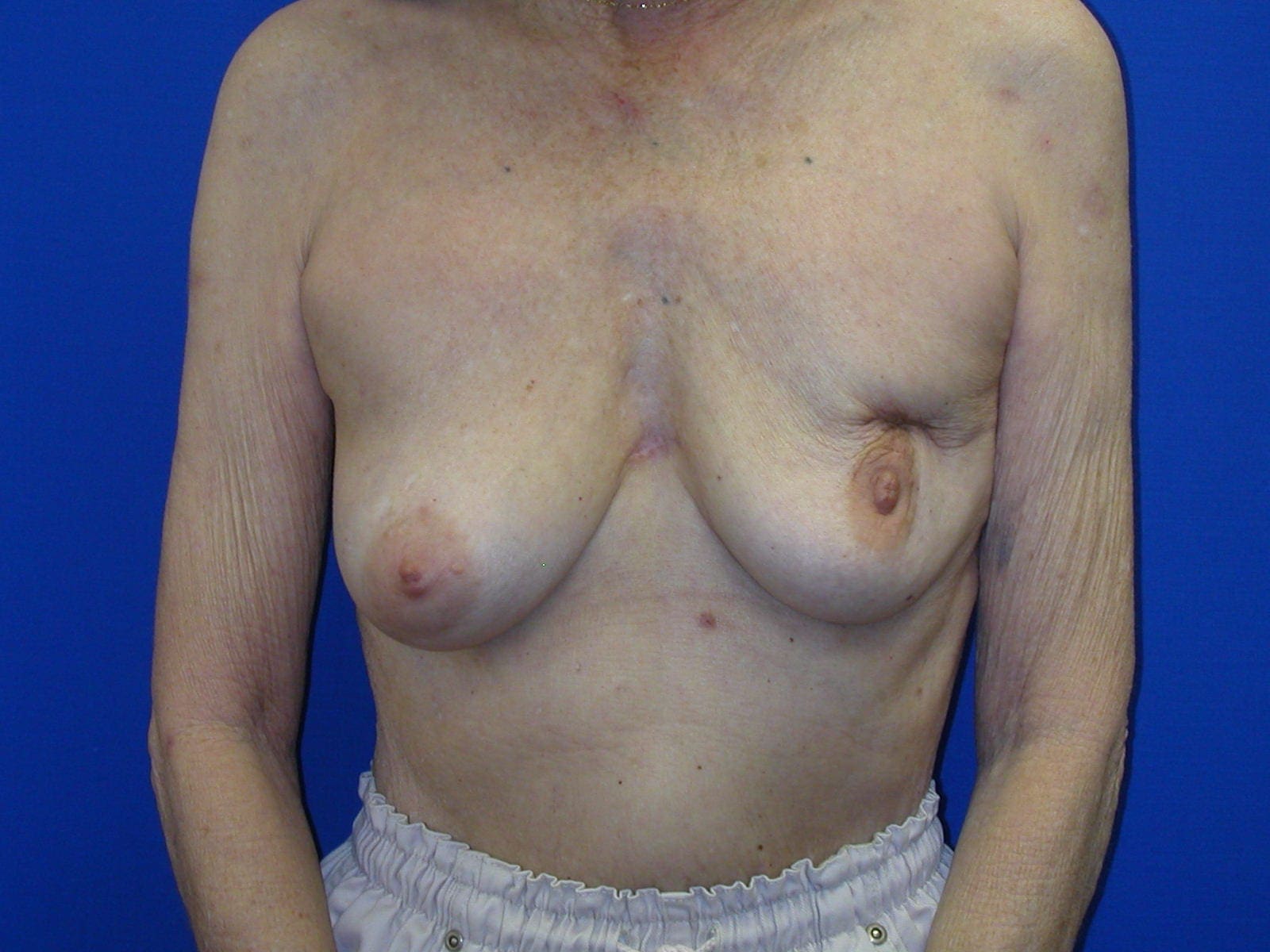 Breast Reconstruction - Case 79 - Before