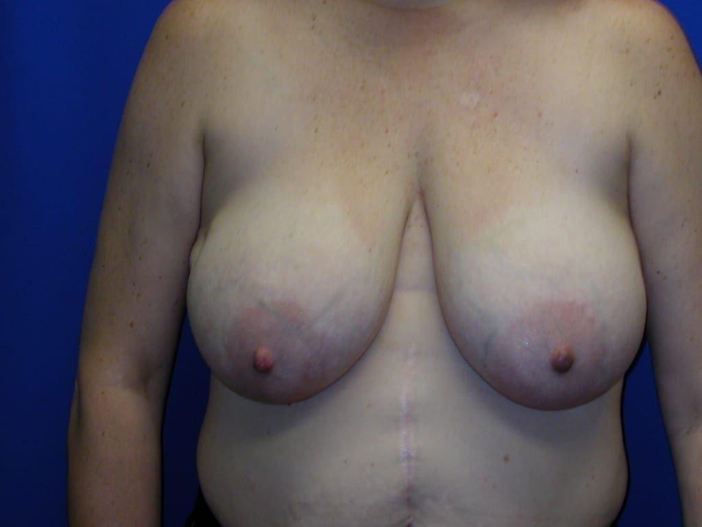 Breast Reconstruction Patient Photo - Case 80 - before view-1