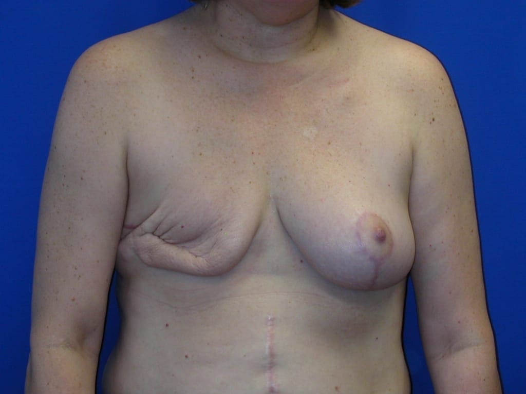 Breast Reconstruction Patient Photo - Case 80 - before view-