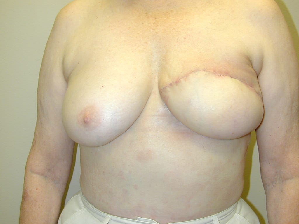 Breast Reconstruction - Case 76 - Before