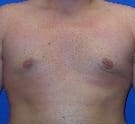 Before and After (for Men) Patient Photo - Case 89 - after view-0