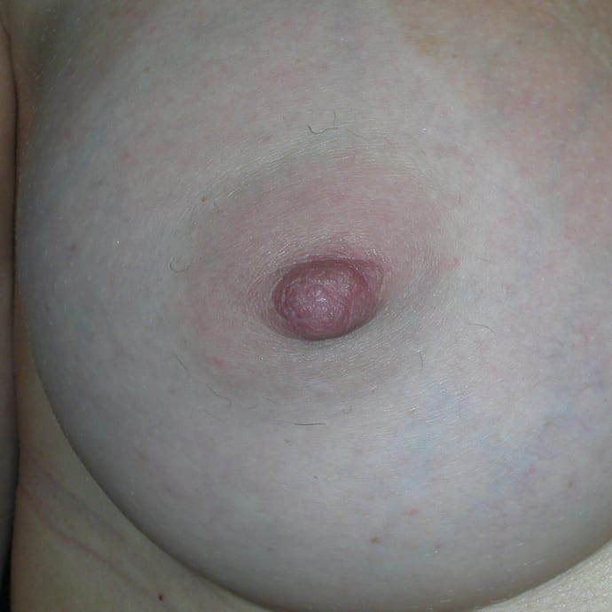 Nipple Reduction Patient Photo - Case 14 - after view