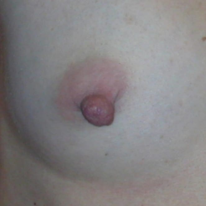 Nipple Reduction Patient Photo - Case 14 - before view-