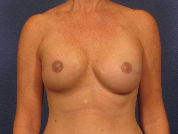 Breast Reconstruction - Case 144 - After