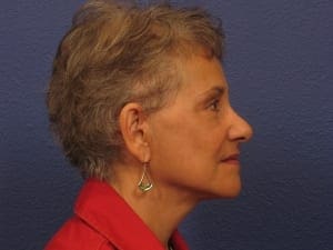 Facelift Patient Photo - Case 145 - after view-1