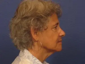 Facelift Patient Photo - Case 145 - before view-1