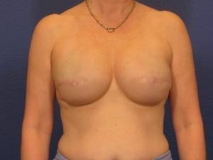 Breast Reconstruction Patient Photo - Case 146 - after view-1