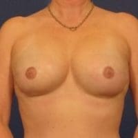 Breast Reconstruction - Case 146 - After