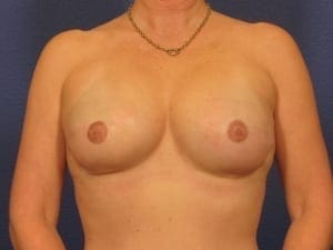 Breast Reconstruction Patient Photo - Case 146 - after view