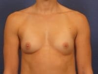 Breast Augmentation Patient Photo - Case 147 - before view-