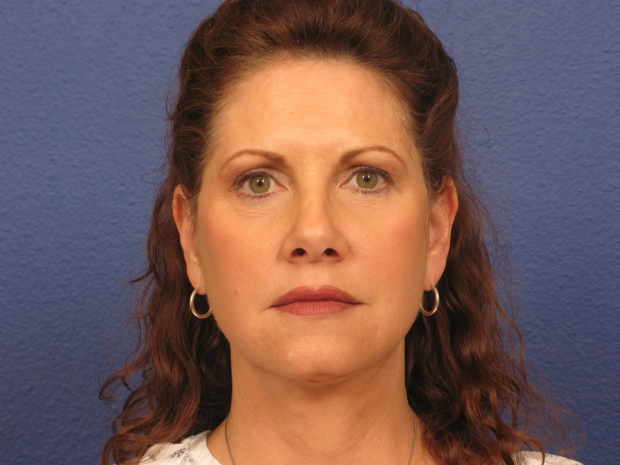 Facelift Patient Photo - Case 148 - after view