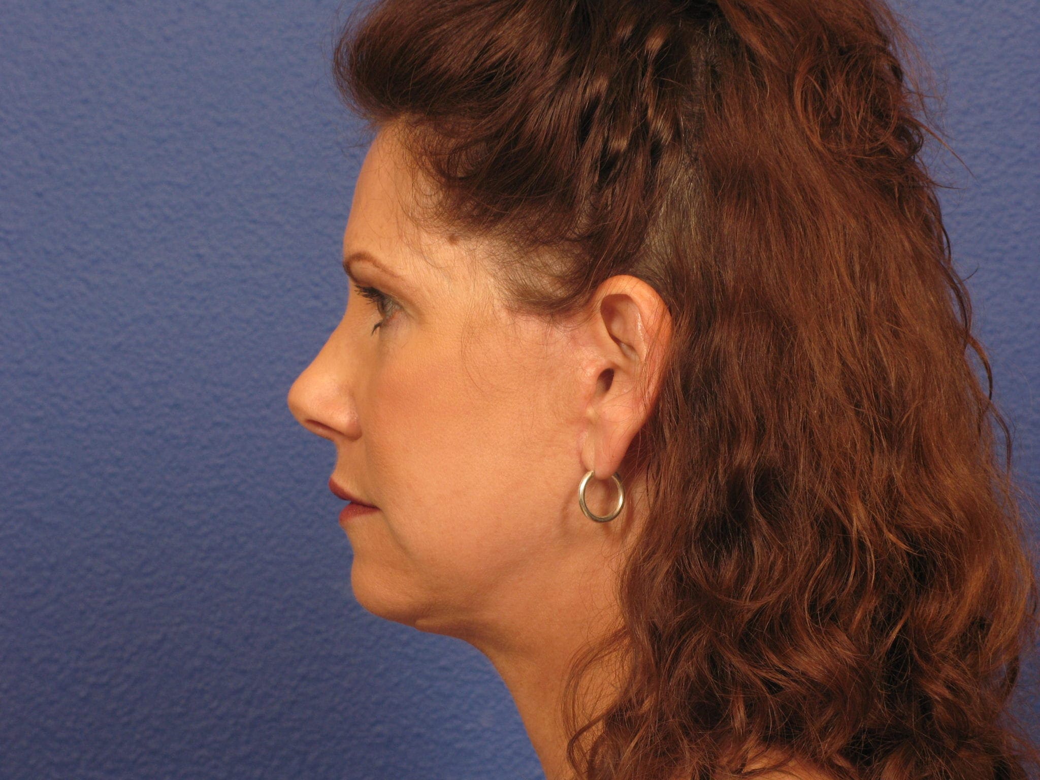 Facelift Patient Photo - Case 148 - after view-1