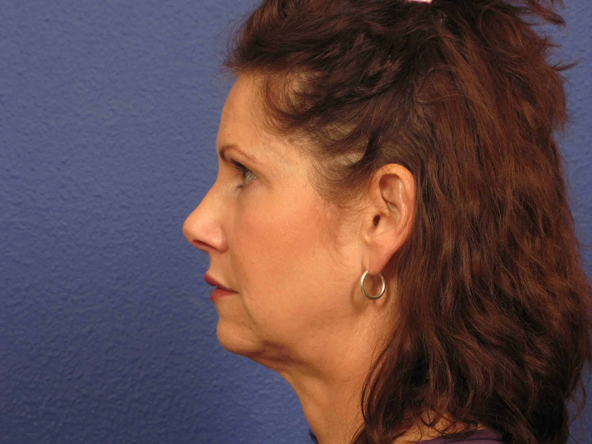 Facelift Patient Photo - Case 148 - before view-1