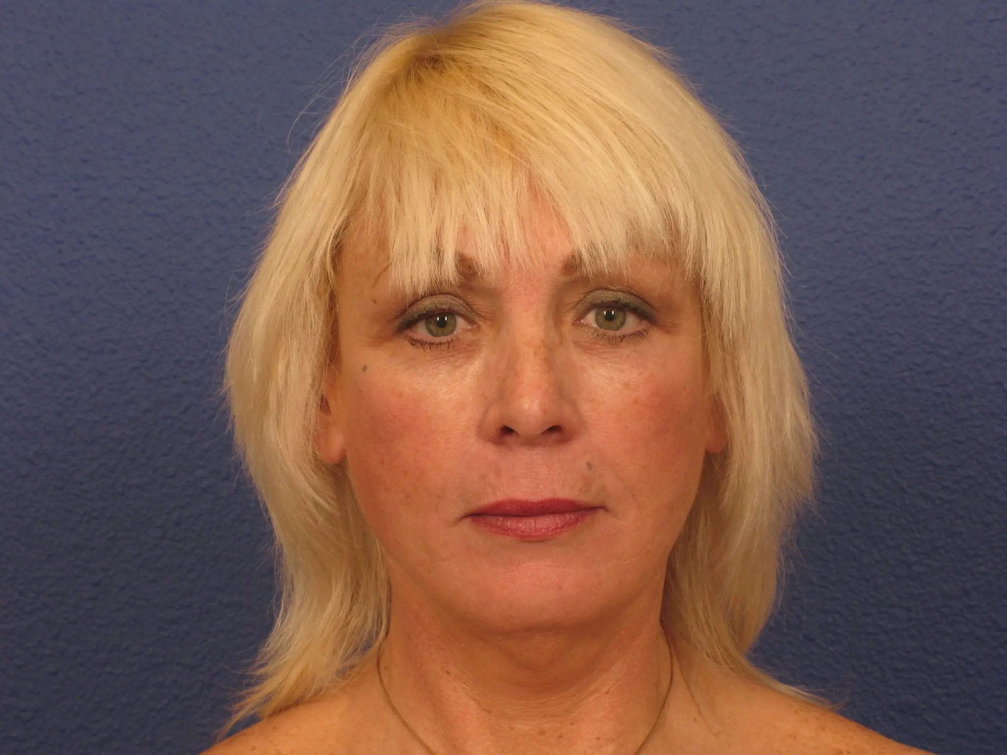 Facelift Patient Photo - Case 150 - after view