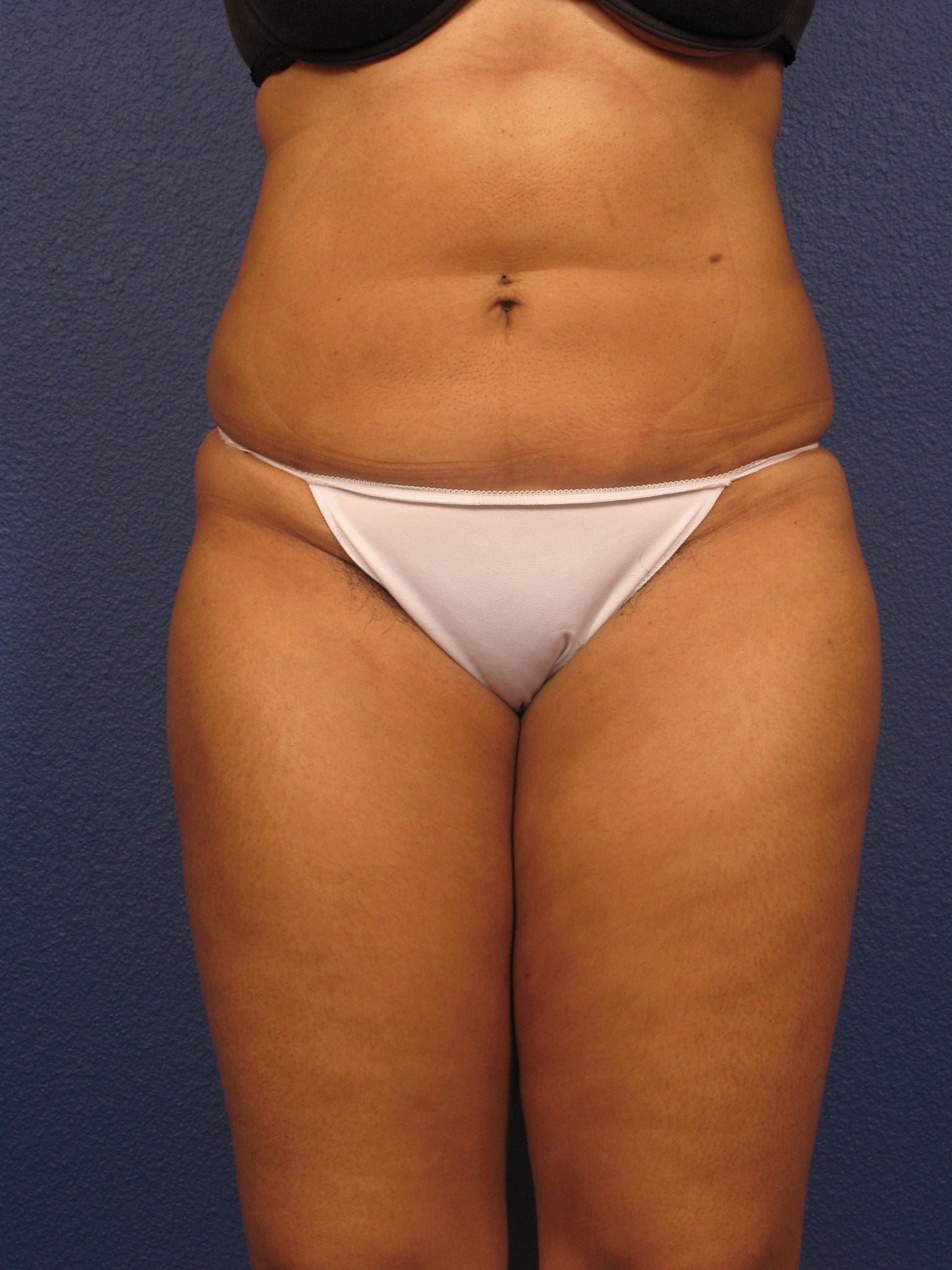 Liposuction Patient Photo - Case 156 - after view