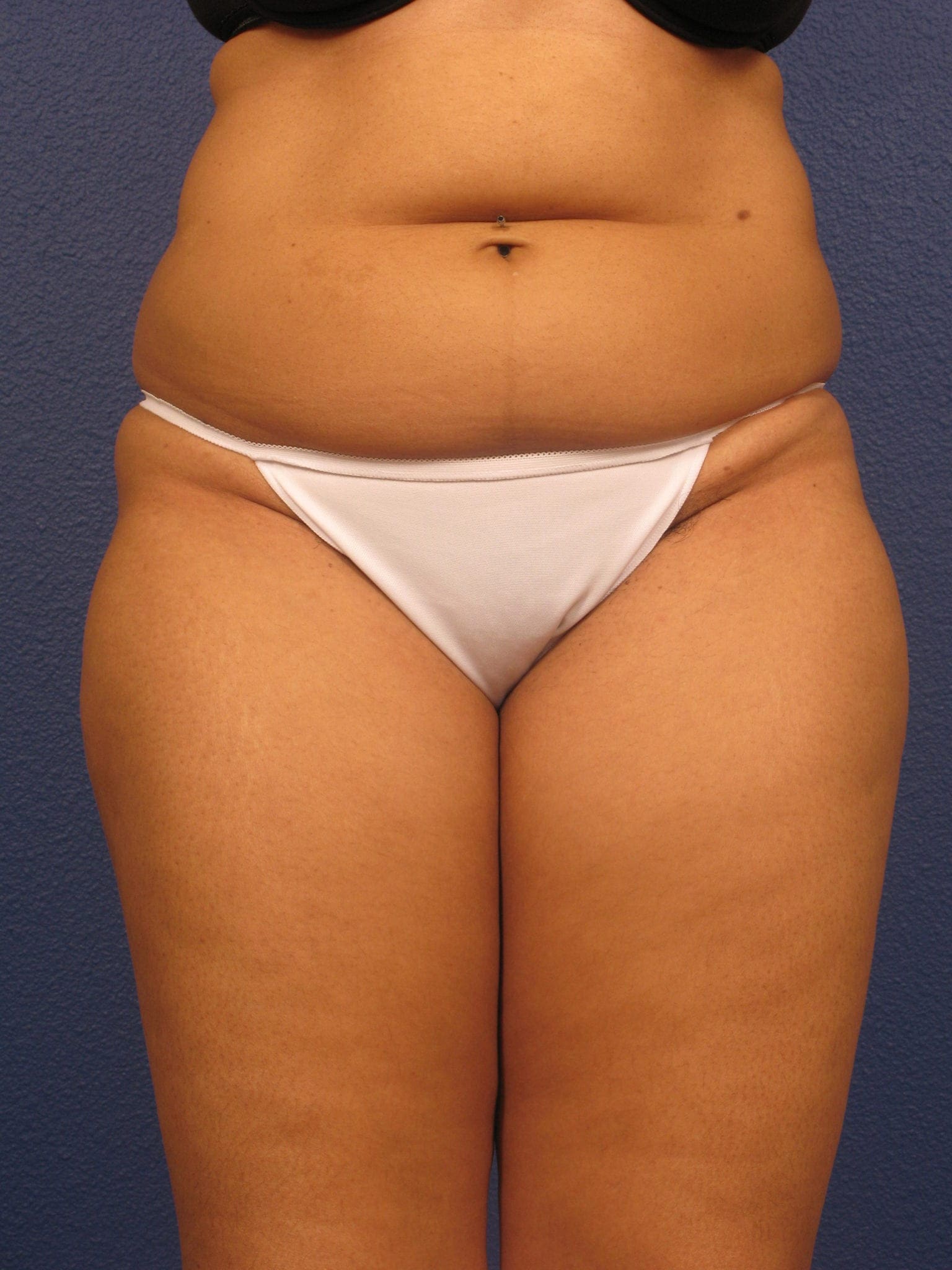 Liposuction Patient Photo - Case 156 - before view-