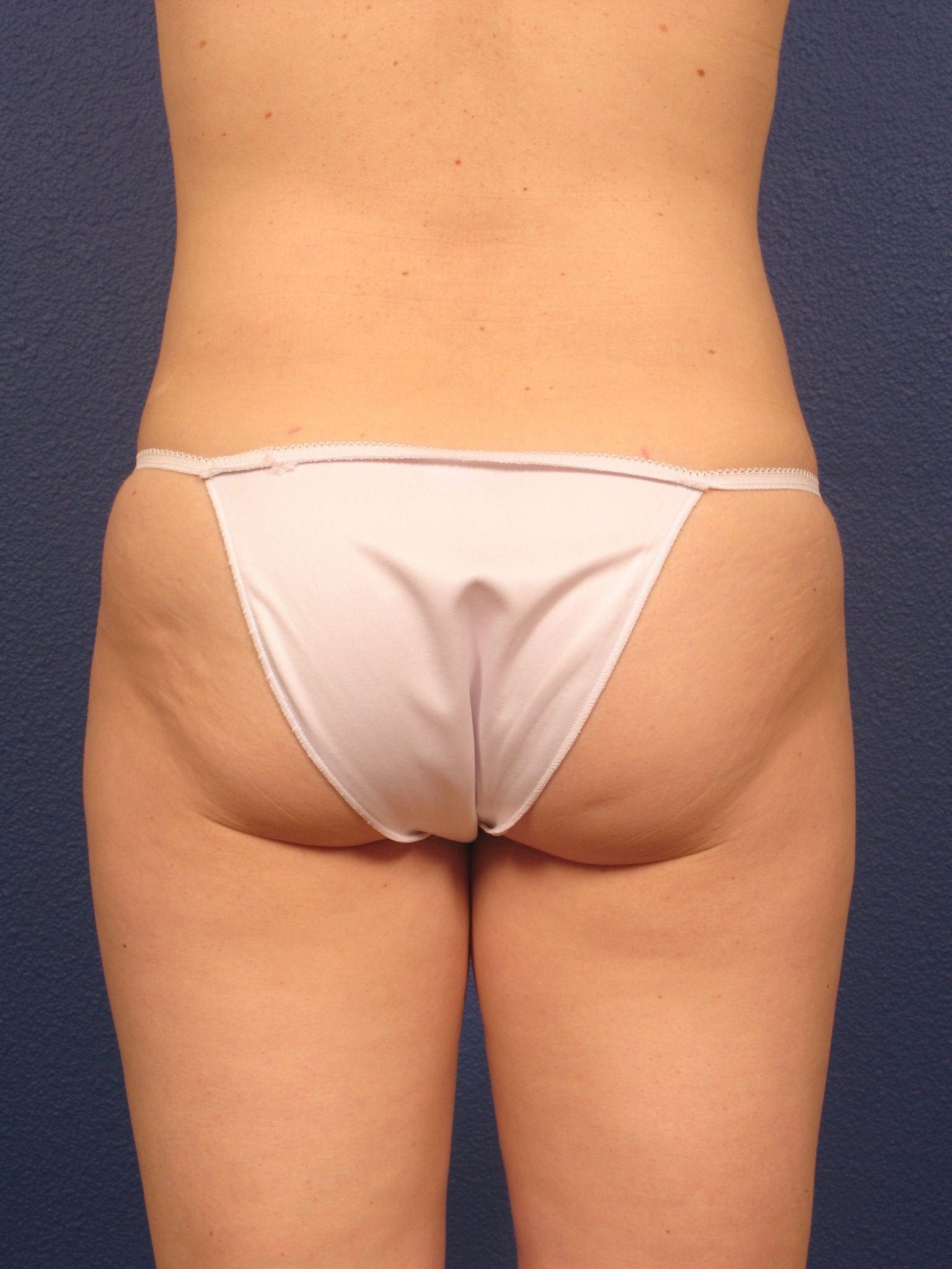 Liposuction Patient Photo - Case 166 - after view-3