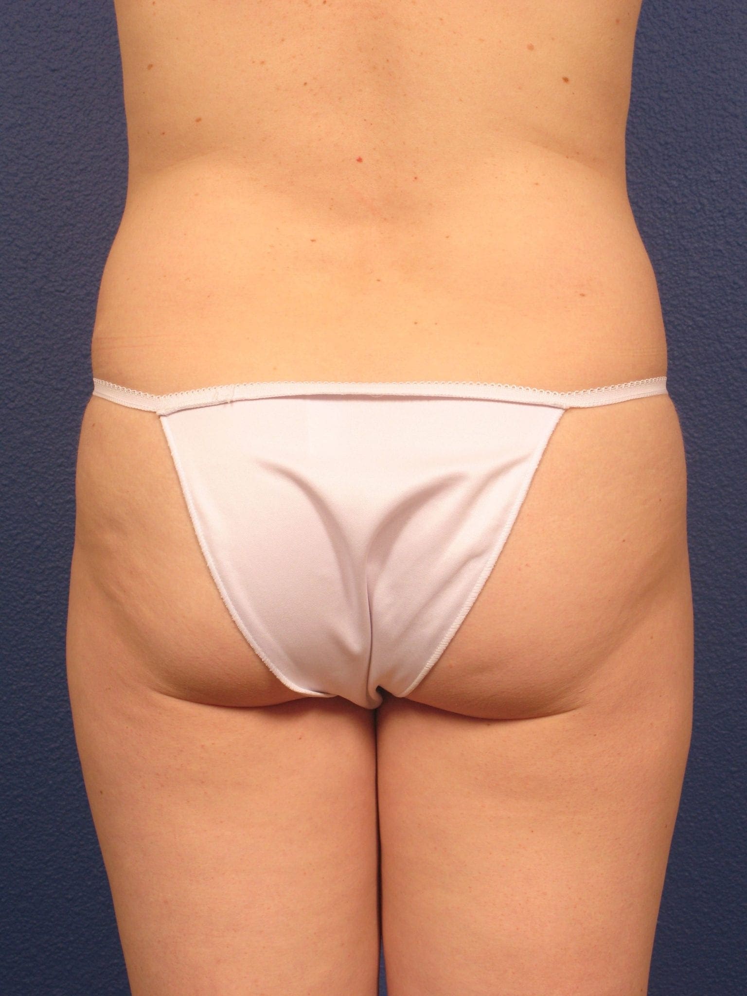 Liposuction Patient Photo - Case 166 - before view-3