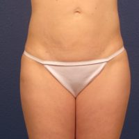 Liposuction - Case 166 - After