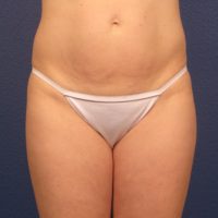 Liposuction - Case 166 - Before