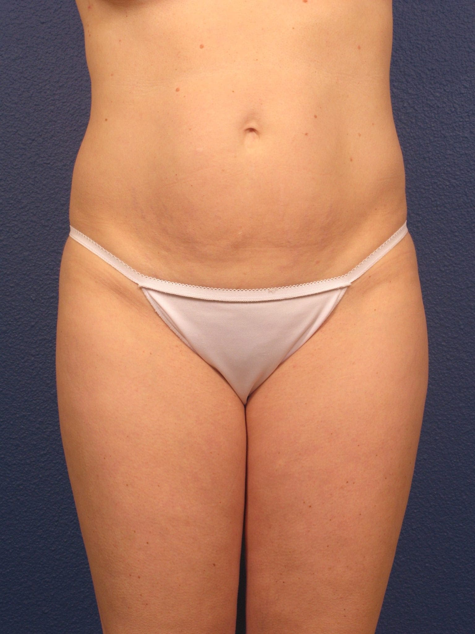 Liposuction Patient Photo - Case 166 - before view-