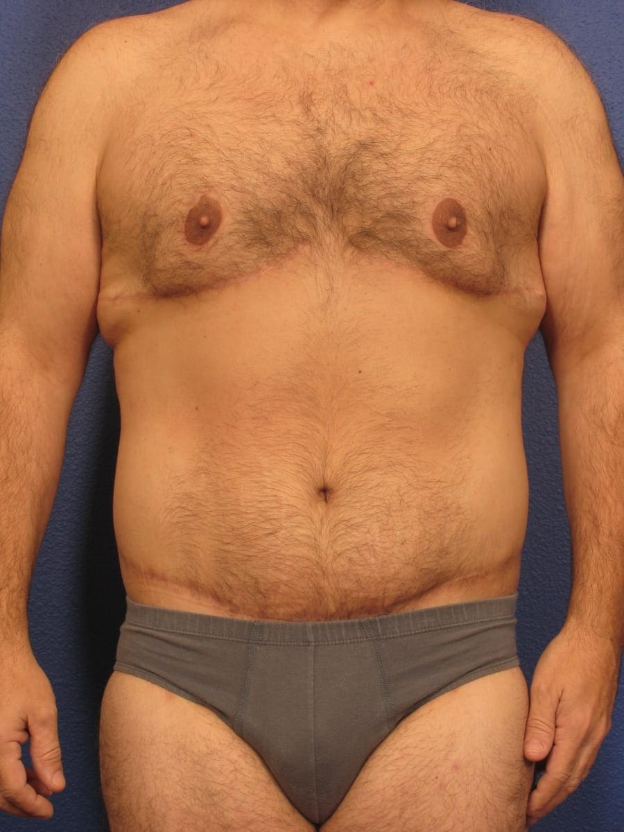 Before and After (for Men) Patient Photo - Case 175 - after view-3