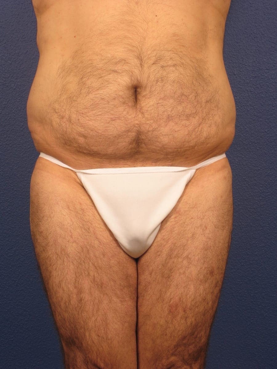 Before and After (for Men) Patient Photo - Case 175 - before view-3