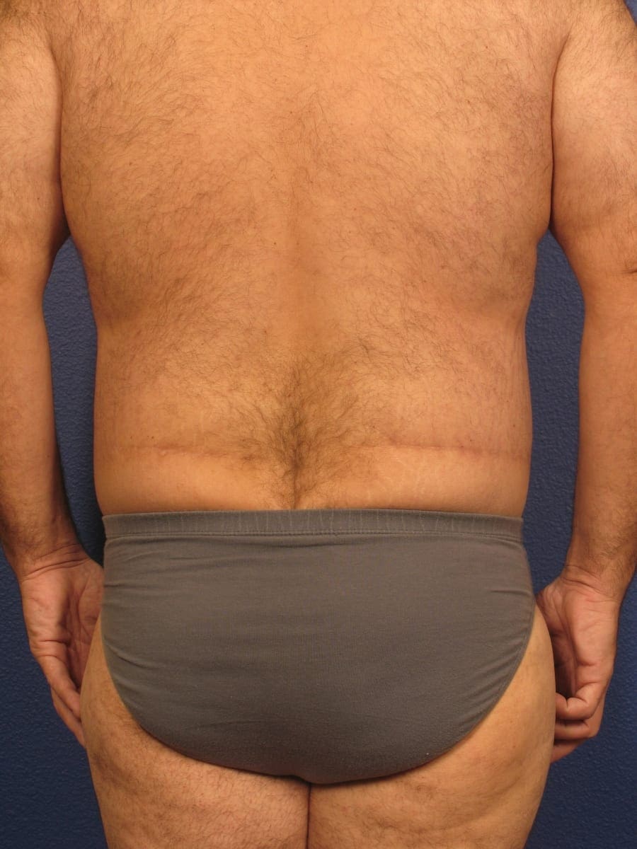 Before and After (for Men) Patient Photo - Case 175 - after view-2