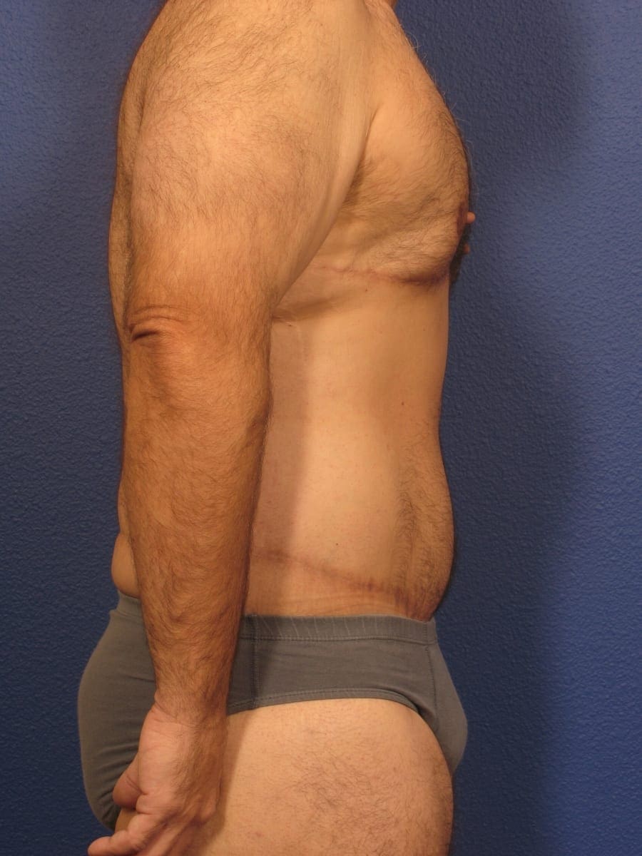 Before and After (for Men) Patient Photo - Case 175 - after view-1