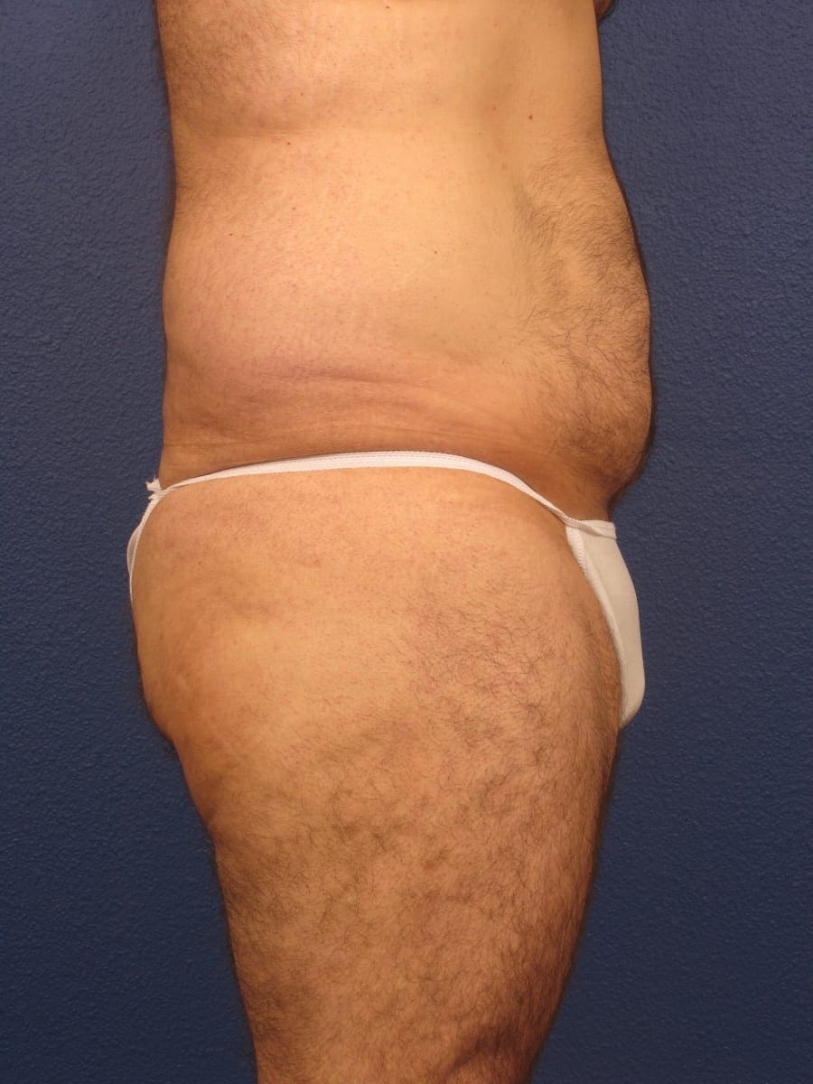 Before and After (for Men) Patient Photo - Case 175 - before view-1