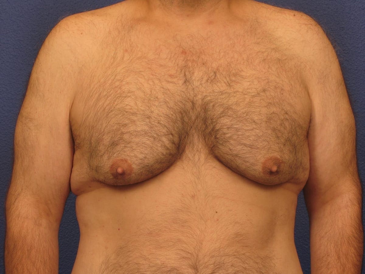 Before and After (for Men) Patient Photo - Case 175 - before view-